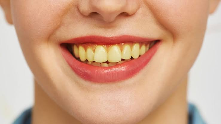 पीले दांतों की वजह से मुस्कुराने में होती है झिझक, तो घर की इन चीजों को मिलाकर कर लीजिए ये काम, चमक जाएंगे दांत